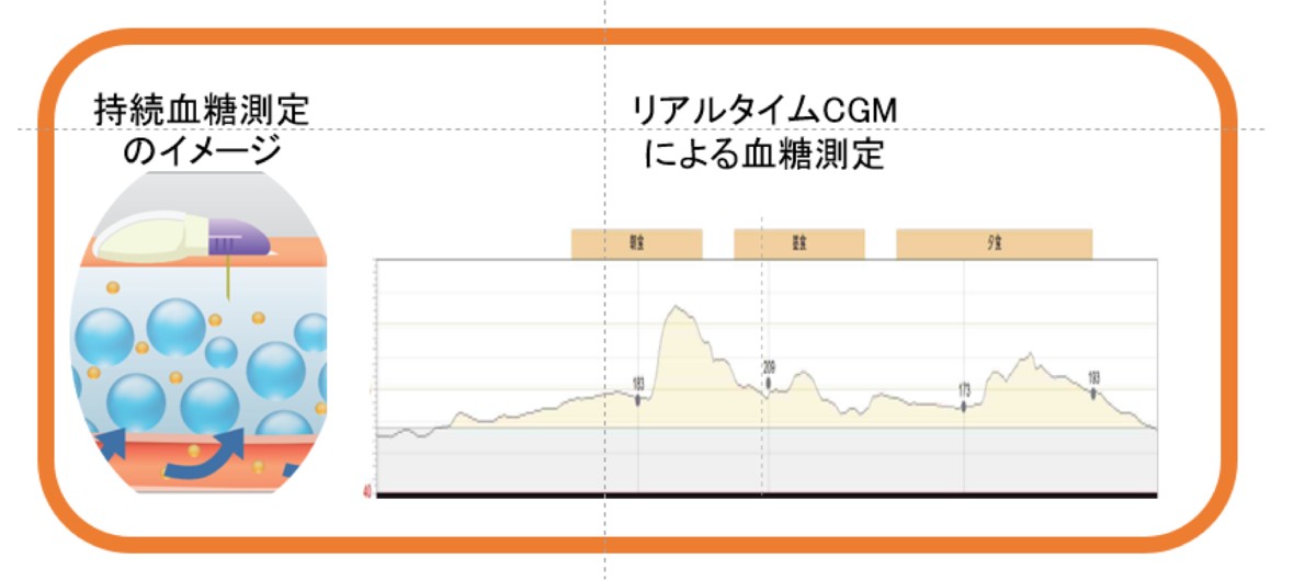 インスリンポンプ療法